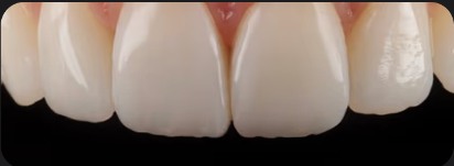 Shaping and polishing composite bonding at Fresh Dental
